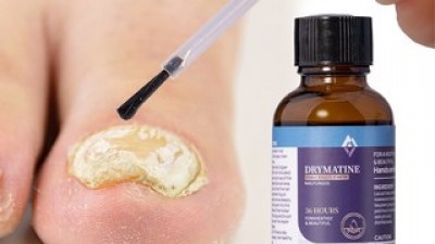 발톱무좀진균제 올해 화제의 아이템